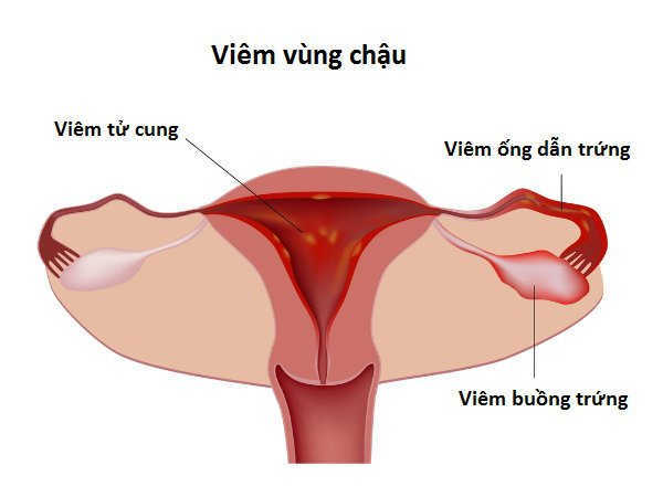 Ảnh minh họa viêm vùng chậu ở nữ giới