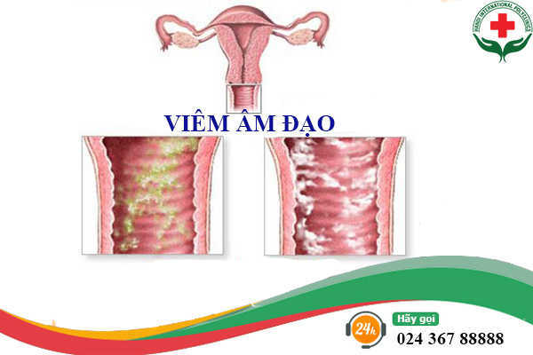 Viêm âm đạo gây mùi ở vùng kín