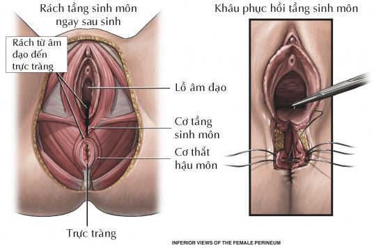 Thu hẹp tầng sinh môn ở nữ giới