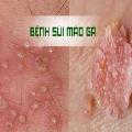 5-cach-chua-benh-sui-mao-ga-hieu-qua-nhat-hien-nay