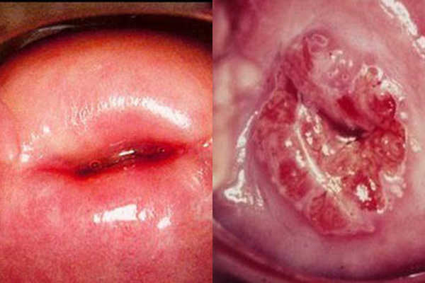 Ung thư cổ tử cung gây chảy máu âm đạo