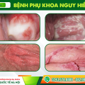 trieu-chung-benh-phu-khoa-va-cach-chua-tot-nhat-hien-nay