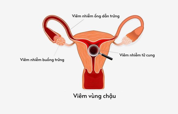 viêm vùng chậu
