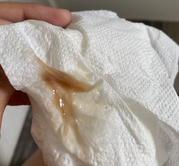 Khí hư lẫn máu màu nâu Khí hư lẫn máu màu nâu