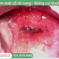 viem-loet-co-tu-cung