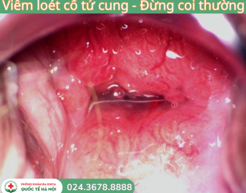 viem-loet-co-tu-cung