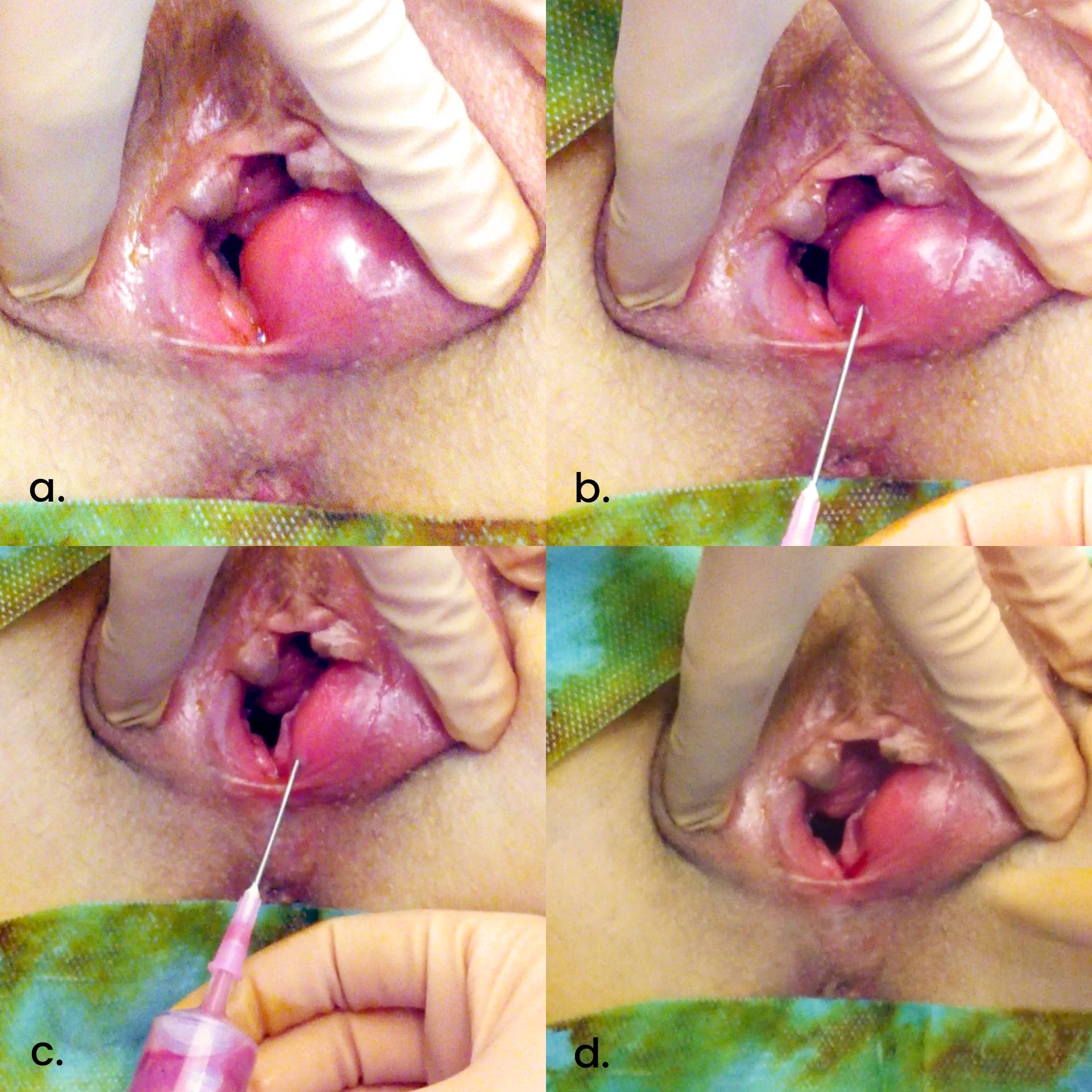 bartholin để lâu