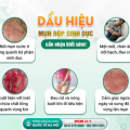 mun-rop-sinh-duc-co-the-deo-bam-ban-ca-doi-nhan-biet-som-de-dieu-tri-hieu-qua