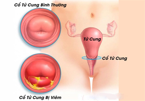 canh-bao-5-dau-hieu-to-cao-co-tu-cung-dang-gap-van-de-nghiem-trong