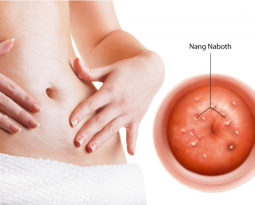 chua-nang-naboth-the-nao-moi-dung-bac-si-noi-ro-tung-cach-dieu-tri-va-toan-bo-chi-phi