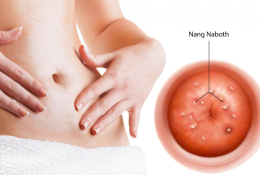 chua-nang-naboth-the-nao-moi-dung-bac-si-noi-ro-tung-cach-dieu-tri-va-toan-bo-chi-phi